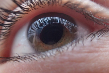 vitreous feature`d